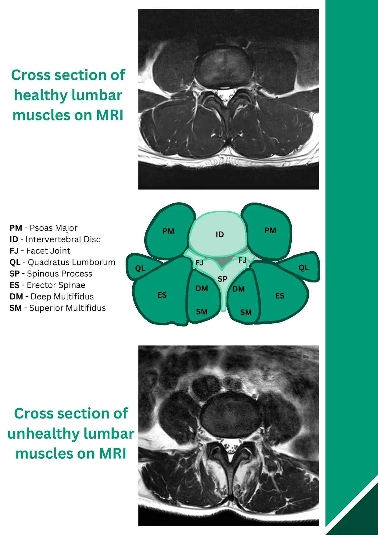 ReActiv8 booklet, page 5 of 16: Healthy and unhealthy lumbar muscles on MRI