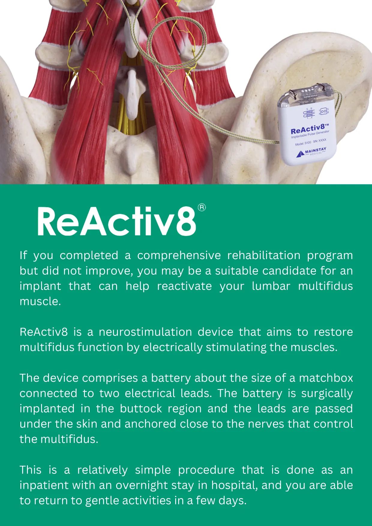 ReActiv8 booklet, page 6 of 16: ReActiv8: what it is and how it is implanted