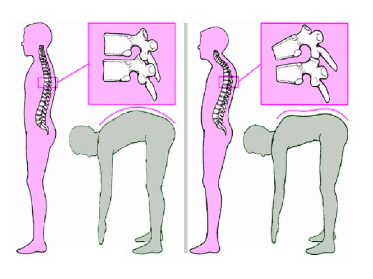 Scheuermann’s Disease - SpinePlus